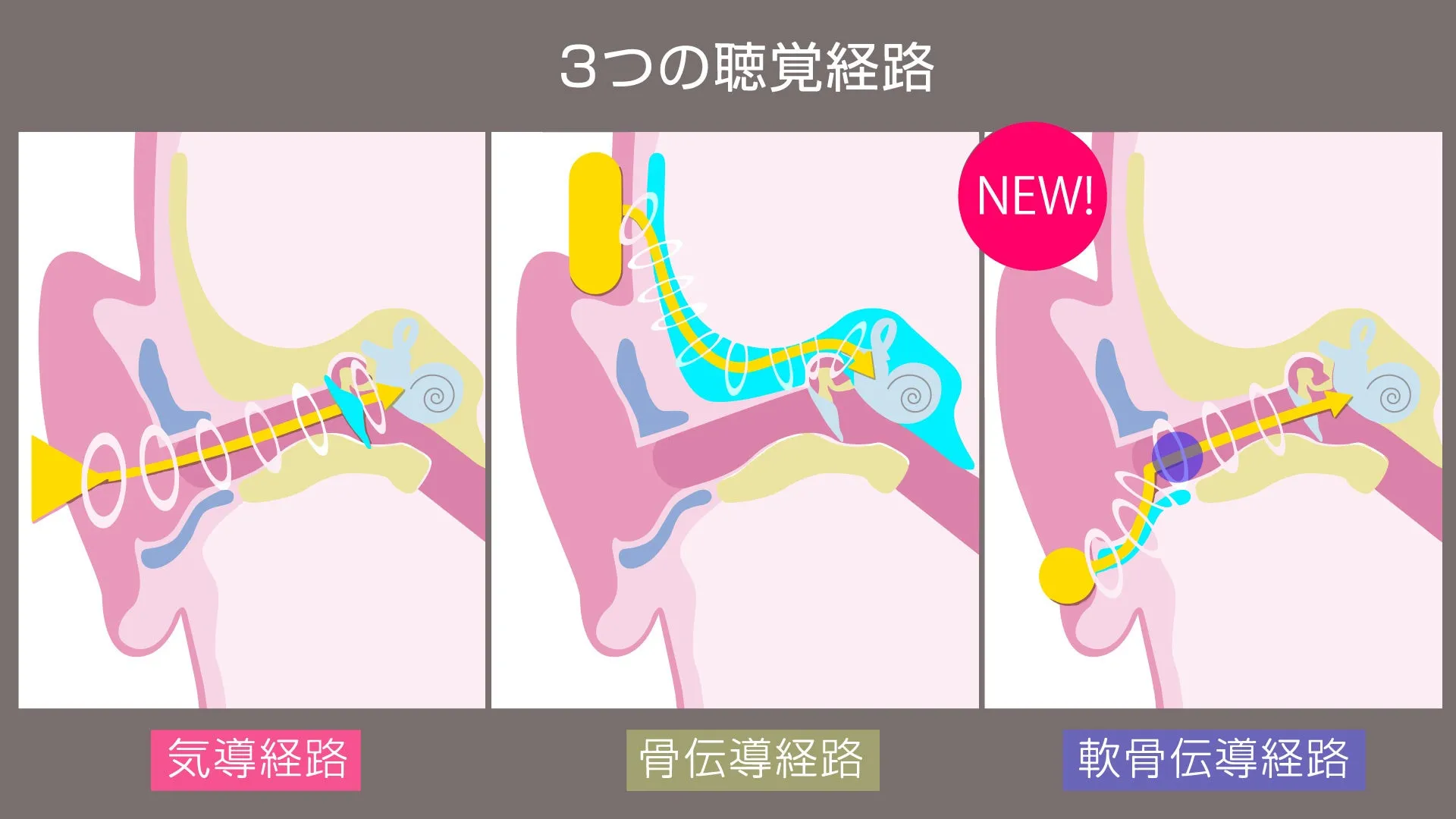 音を内耳に伝える3つの主要な聴覚経路を示すイラスト